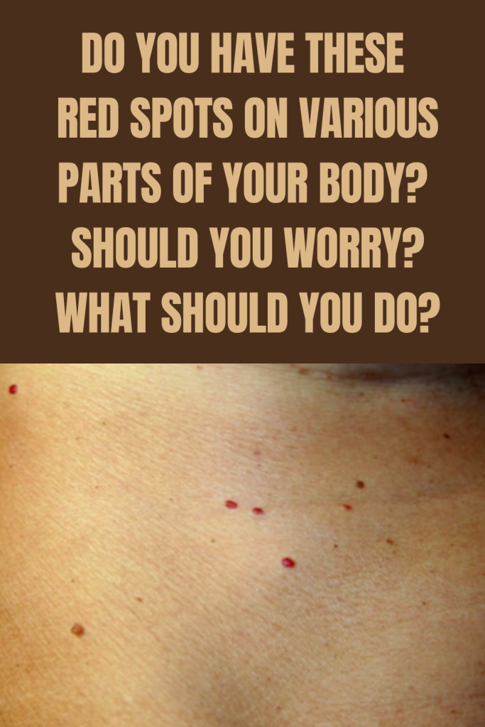 DO YOU HAVE THESE RED SPOTS ON VARIOUS PARTS OF YOUR BODY? SHOULD YOU WORRY? WHAT SHOULD YOU DO?