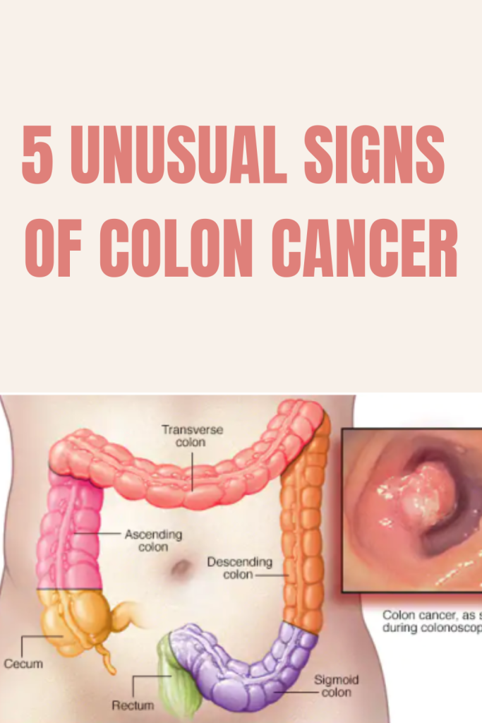 5 Unusual Signs Of Colon Cancer